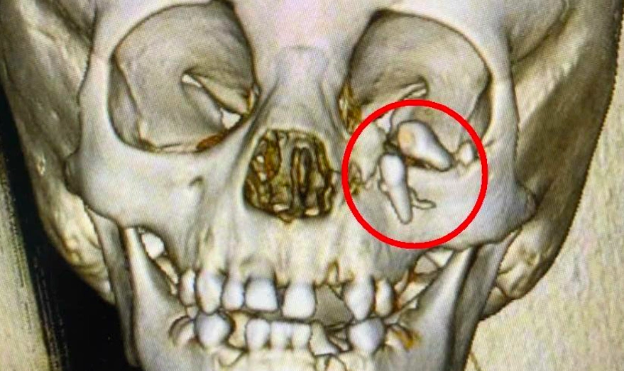 Bệnh viện Việt Đức cứu sống bé trai 26 tháng tuổi bị chó nhà cắn chấn thương nghiêm trọng vùng mặt