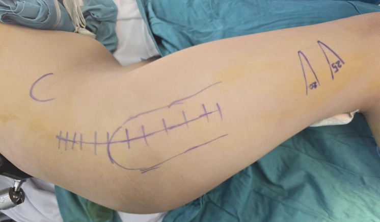 Ca mổ khớp 9 tiếng giúp thiếu niên thoát 'hội chứng ngày sinh nhật'