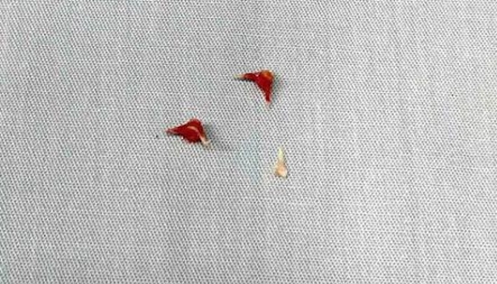 Nguy kịch vì hóc xương lươn: Bé trai 7 tháng tuổi phải thở máy do dị vật găm sâu đường thở