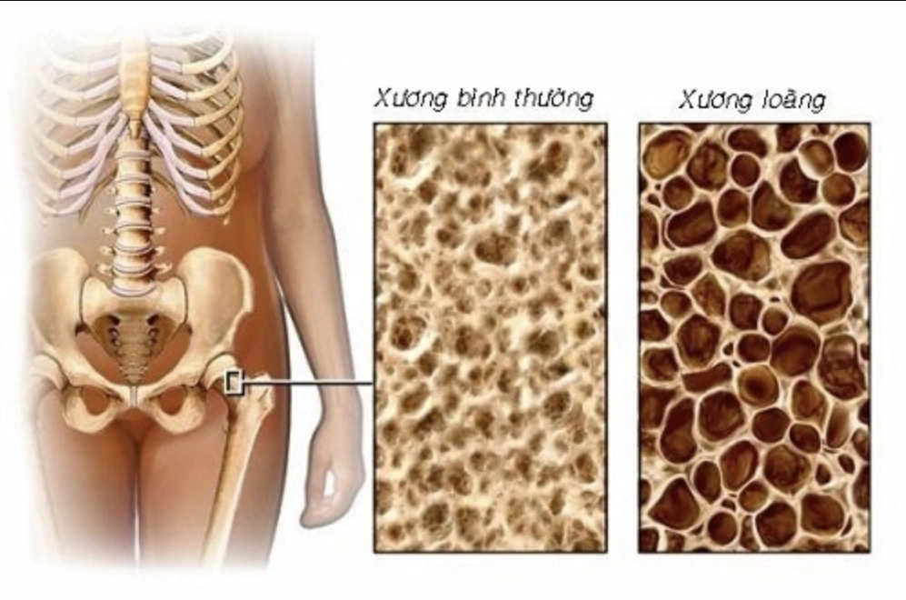 Những đối tượng được khuyến cáo nên đo loãng xương sớm bằng phương pháp DXA