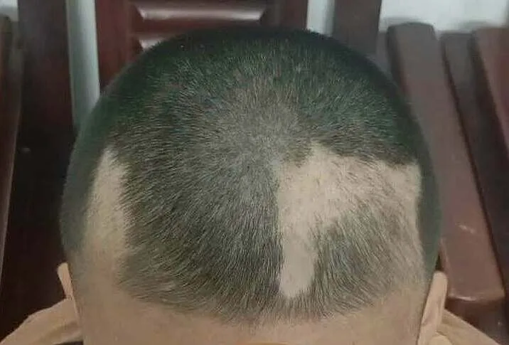 Bé trai 12 tuổi nhổ trụi từng mảng tóc vì áp lực ôn thi